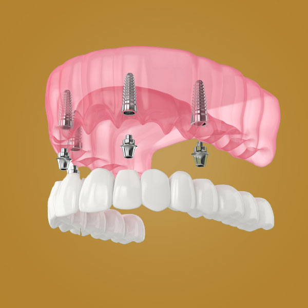 Key Benefits of All-on-4 Treatment